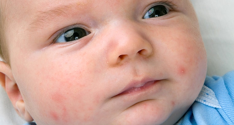 comment soigner l'acné du nourrisson ?